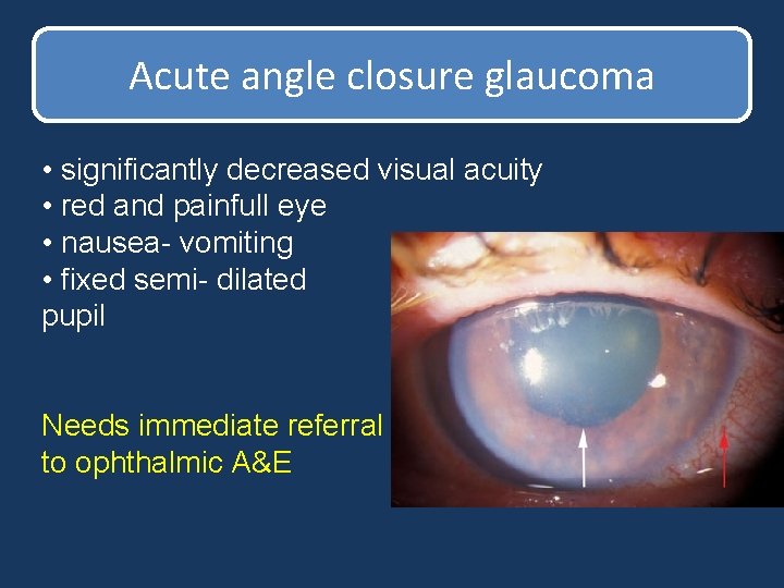 Acute angle closure glaucoma • significantly decreased visual acuity • red and painfull eye Acute angle closure glaucoma • significantly decreased visual acuity • red and painfull eye
