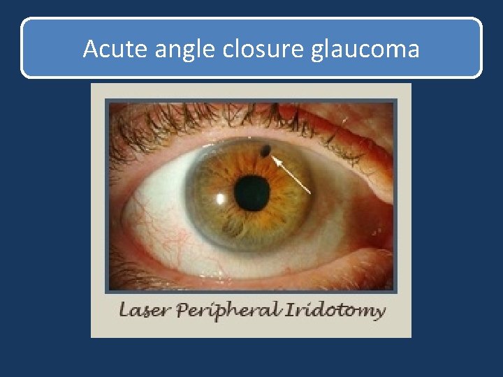 Acute angle closure glaucoma Acute angle closure glaucoma