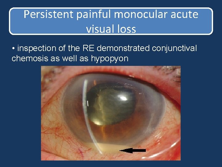Persistent painful monocular acute visual loss • inspection of the RE demonstrated conjunctival chemosis Persistent painful monocular acute visual loss • inspection of the RE demonstrated conjunctival chemosis