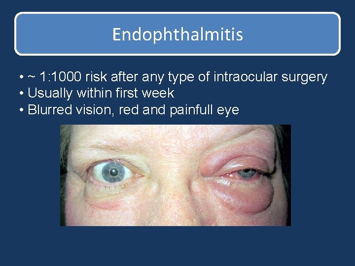 Endophthalmitis • ~ 1: 1000 risk after any type of intraocular surgery • Usually Endophthalmitis • ~ 1: 1000 risk after any type of intraocular surgery • Usually