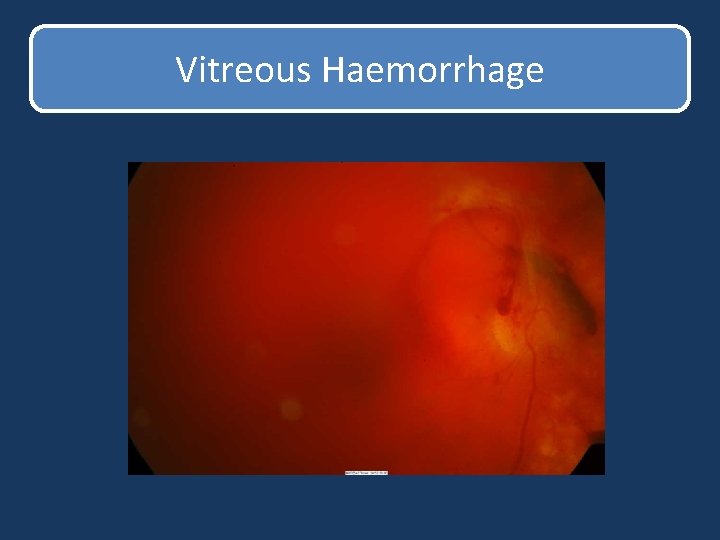 Vitreous Haemorrhage Vitreous Haemorrhage