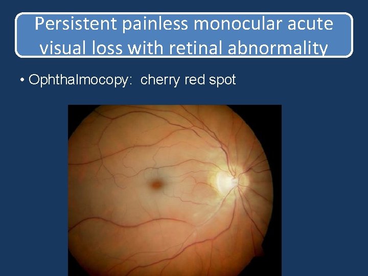 Persistent painless monocular acute visual loss with retinal abnormality • Ophthalmocopy: cherry red spot Persistent painless monocular acute visual loss with retinal abnormality • Ophthalmocopy: cherry red spot