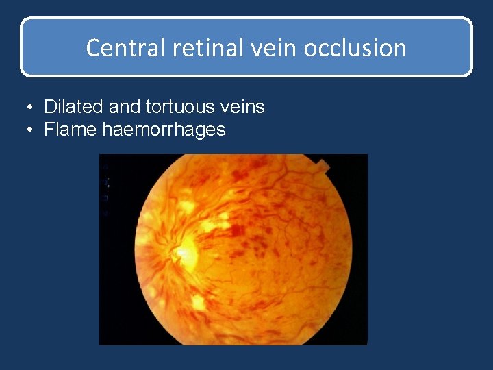 Central retinal vein occlusion • Dilated and tortuous veins • Flame haemorrhages Central retinal vein occlusion • Dilated and tortuous veins • Flame haemorrhages