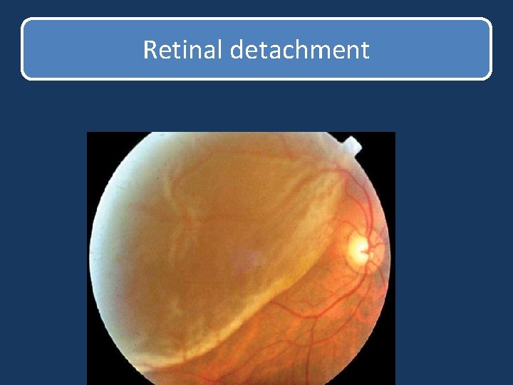 Retinal detachment Retinal detachment