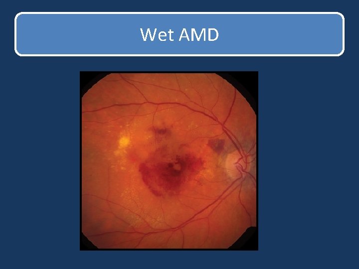 Wet AMD Wet AMD