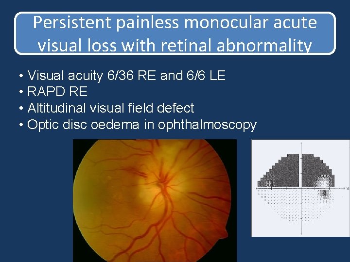 Persistent painless monocular acute visual loss with retinal abnormality • Visual acuity 6/36 RE Persistent painless monocular acute visual loss with retinal abnormality • Visual acuity 6/36 RE