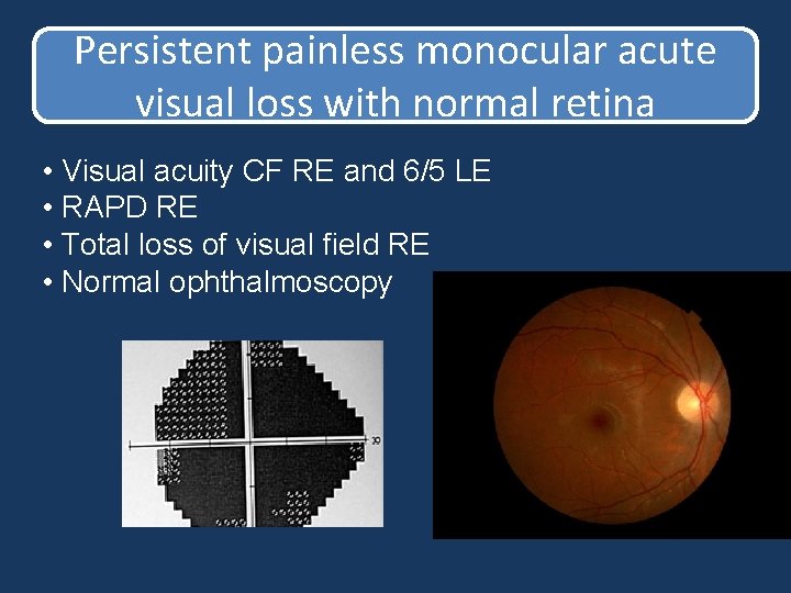 Persistent painless monocular acute visual loss with normal retina • Visual acuity CF RE Persistent painless monocular acute visual loss with normal retina • Visual acuity CF RE