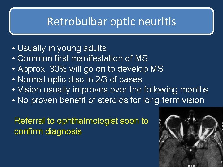 Retrobulbar optic neuritis • Usually in young adults • Common first manifestation of MS Retrobulbar optic neuritis • Usually in young adults • Common first manifestation of MS