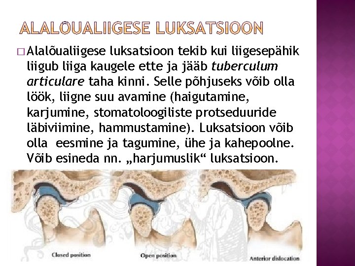 � Alalõualiigese luksatsioon tekib kui liigesepähik liigub liiga kaugele ette ja jääb tuberculum articulare