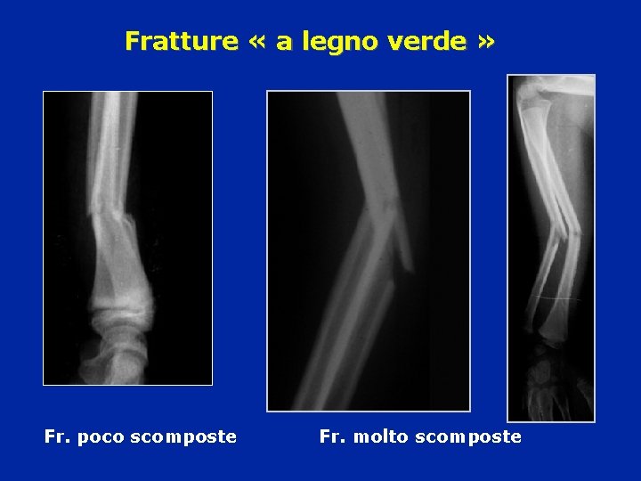 Fratture « a legno verde » Fr. poco scomposte Fr. molto scomposte 