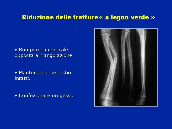 Riduzione delle fratture « a legno verde » • Rompere la corticale opposta all’