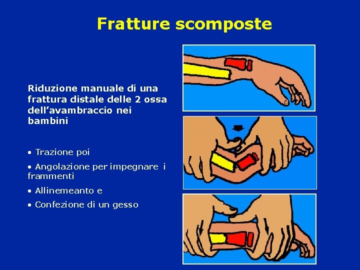 Fratture scomposte Riduzione manuale di una frattura distale delle 2 ossa dell’avambraccio nei bambini