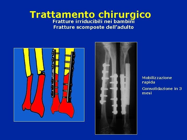 Trattamento chirurgico Fratture irriducibili nei bambini Fratture scomposte dell’adulto Mobilizzazione rapida Consolidazione in 3