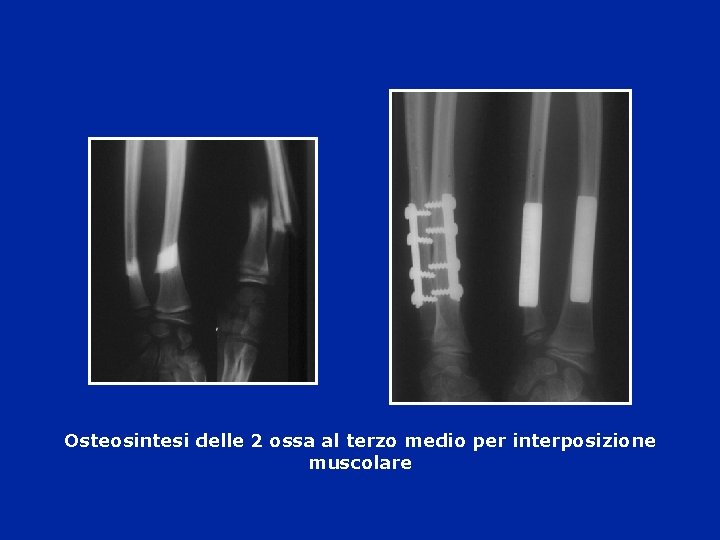 Osteosintesi delle 2 ossa al terzo medio per interposizione muscolare 