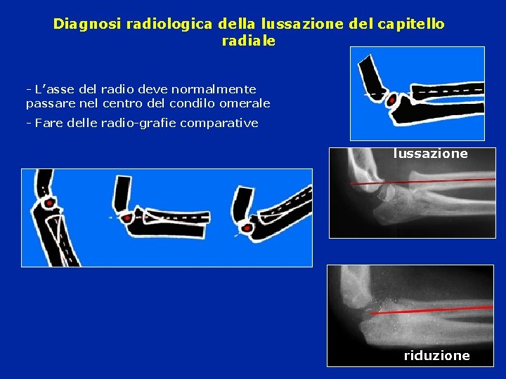 Diagnosi radiologica della lussazione del capitello radiale - L’asse del radio deve normalmente passare