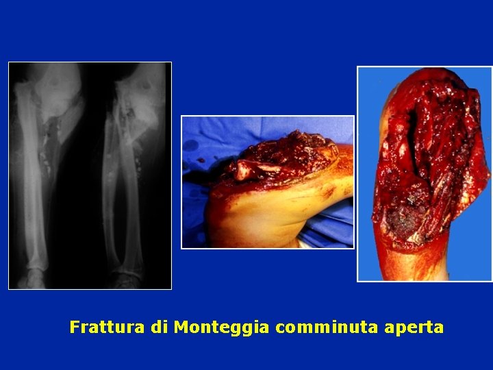 Frattura di Monteggia comminuta aperta 