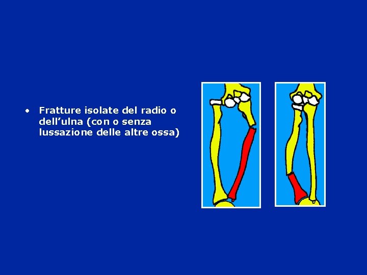  • Fratture isolate del radio o dell’ulna (con o senza lussazione delle altre