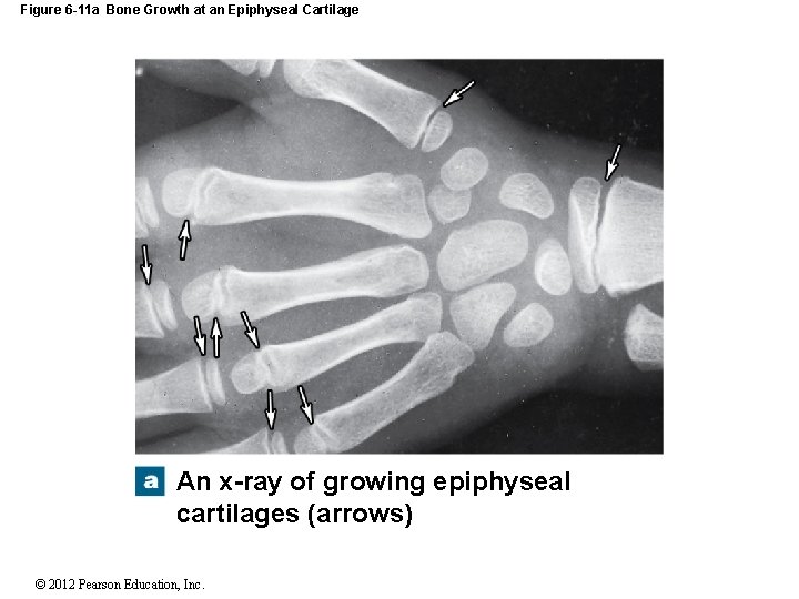 Figure 6 -11 a Bone Growth at an Epiphyseal Cartilage An x-ray of growing