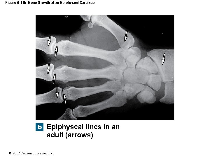 Figure 6 -11 b Bone Growth at an Epiphyseal Cartilage Epiphyseal lines in an