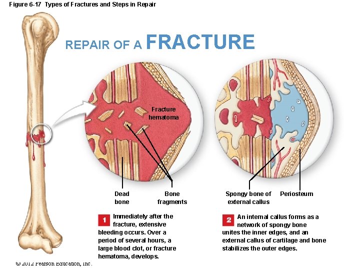 Figure 6 -17 Types of Fractures and Steps in Repair REPAIR OF A FRACTURE