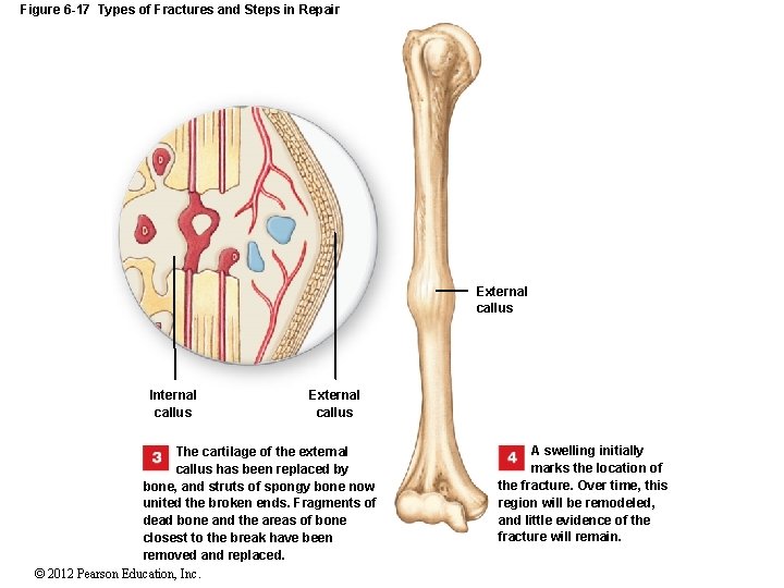 Figure 6 -17 Types of Fractures and Steps in Repair External callus Internal callus