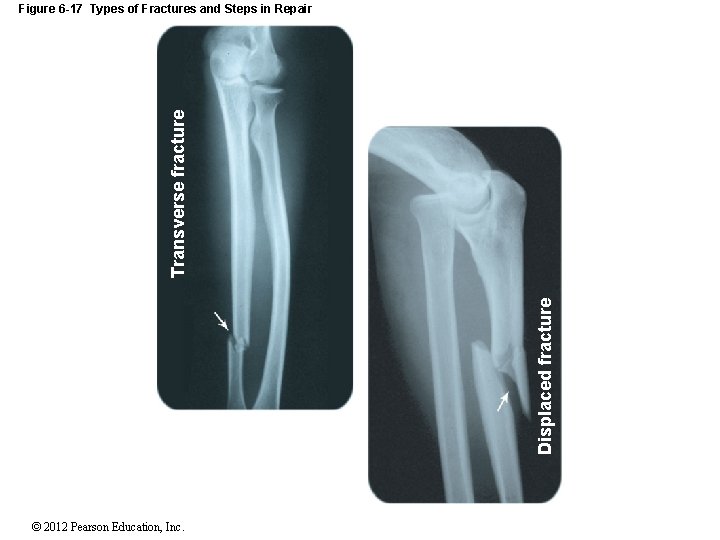 Displaced fracture Transverse fracture Figure 6 -17 Types of Fractures and Steps in Repair