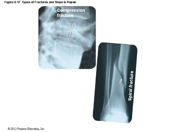 Figure 6 -17 Types of Fractures and Steps in Repair Spiral fracture Compression fracture