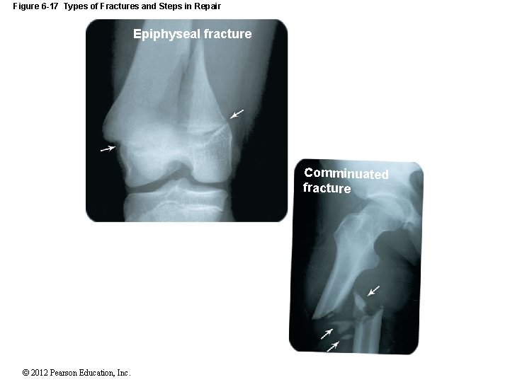 Figure 6 -17 Types of Fractures and Steps in Repair Epiphyseal fracture Comminuated fracture