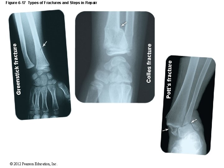 © 2012 Pearson Education, Inc. Pott’s fracture Colles fracture Greenstick f Figure 6 -17