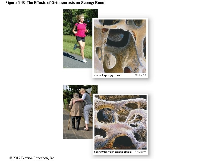 Figure 6 -18 The Effects of Osteoporosis on Spongy Bone © 2012 Pearson Education,