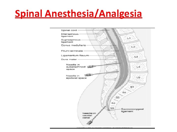 Spinal Anesthesia/Analgesia 