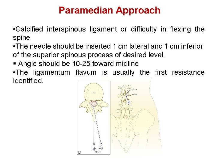 Paramedian Approach • Calcified interspinous ligament or difficulty in flexing the spine • The