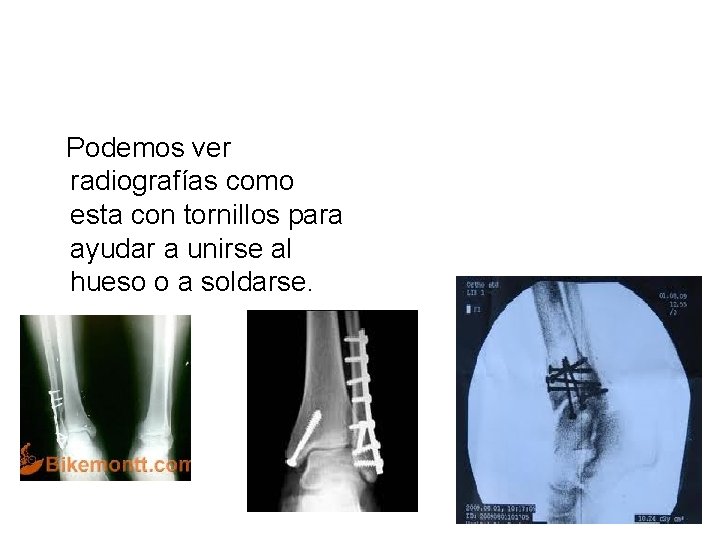 Podemos ver radiografías como esta con tornillos para ayudar a unirse al hueso o