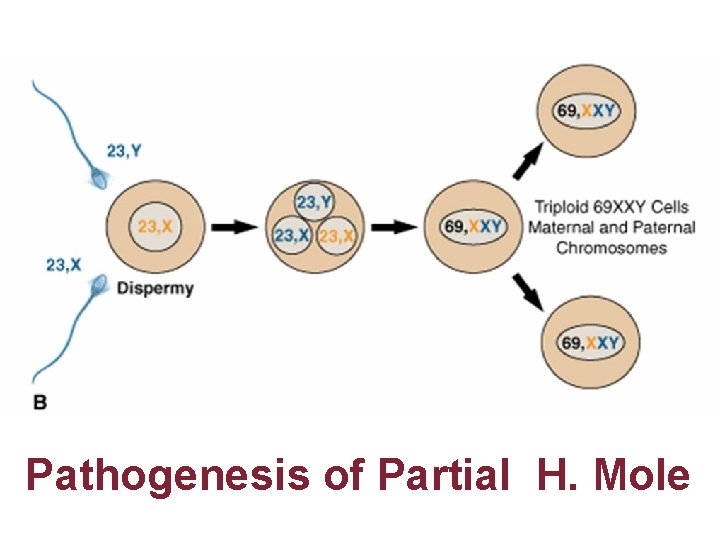 Pathogenesis of Partial H. Mole 