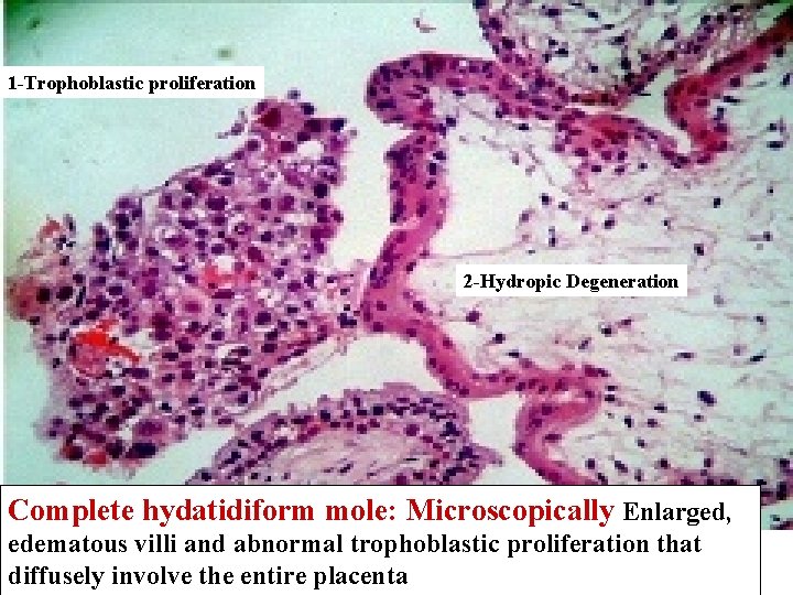 1 -Trophoblastic proliferation 2 -Hydropic Degeneration Complete hydatidiform mole: Microscopically Enlarged, edematous villi and