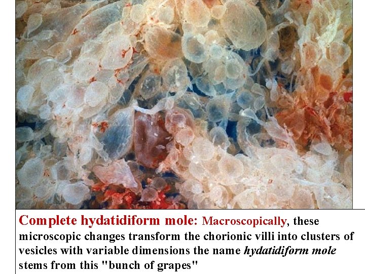 Complete hydatidiform mole: Macroscopically, these microscopic changes transform the chorionic villi into clusters of