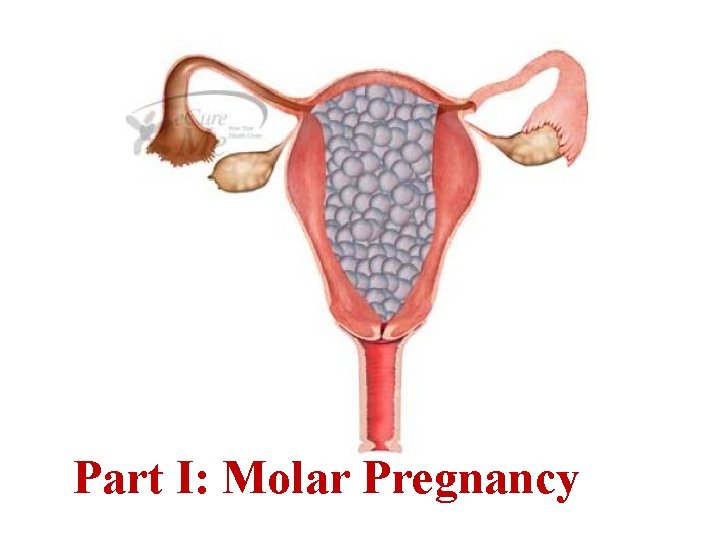 Part I: Molar Pregnancy 