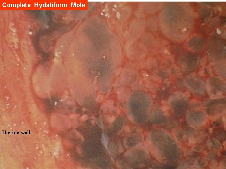 Complete Hydatiform Mole Uterine wall 