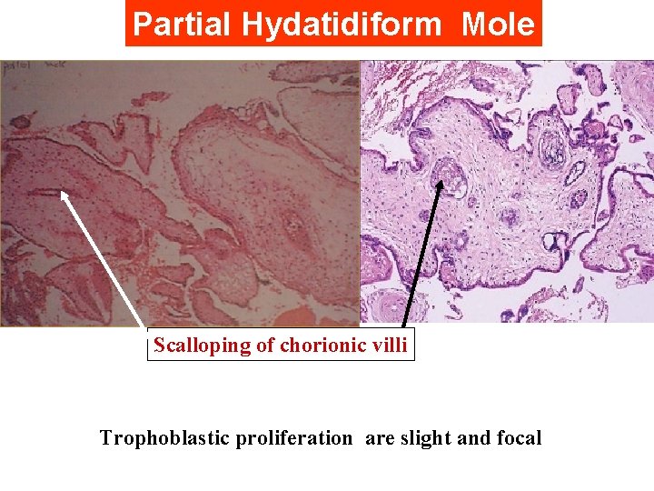 Partial Hydatidiform Mole Scalloping of chorionic villi Trophoblastic proliferation are slight and focal 