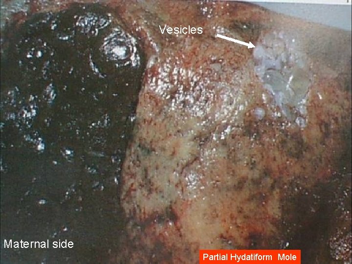 Vesicles Maternal side Partial Hydatiform Mole 