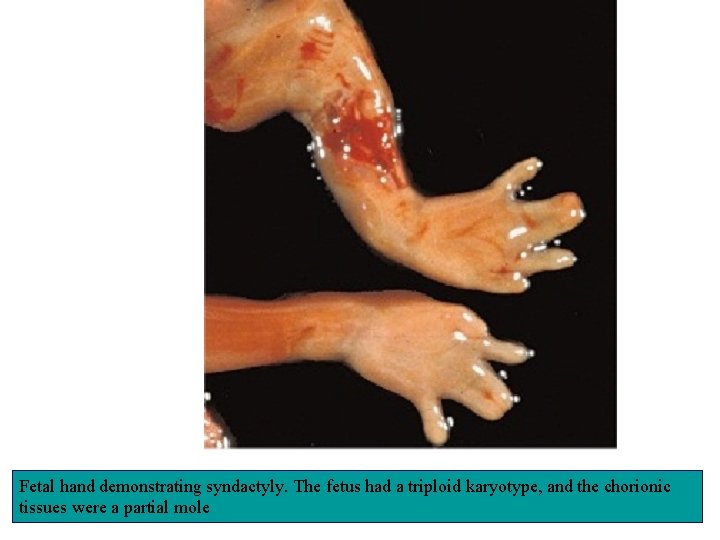 Fetal hand demonstrating syndactyly. The fetus had a triploid karyotype, and the chorionic tissues