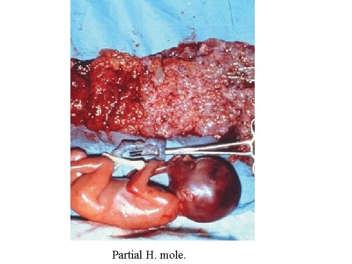 Partial H. mole. 