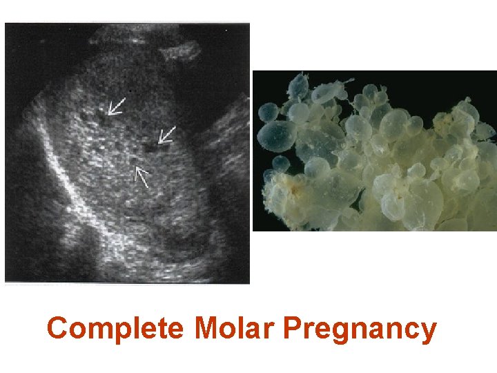 Complete Molar Pregnancy 