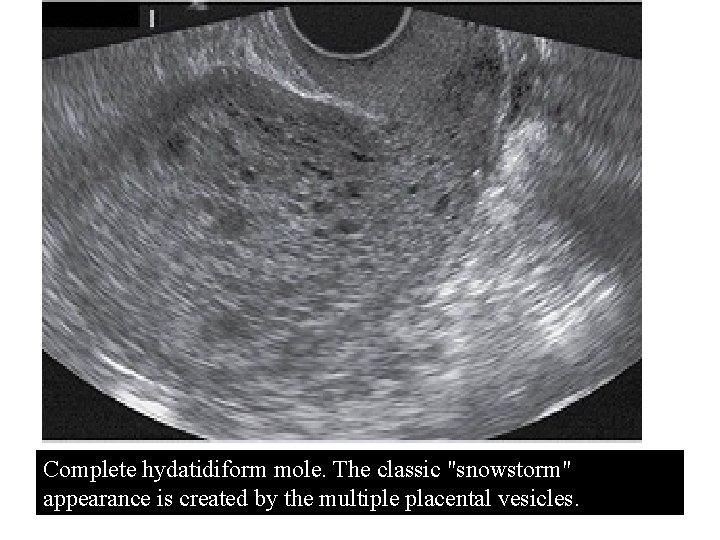 Complete hydatidiform mole. The classic "snowstorm" appearance is created by the multiple placental vesicles.