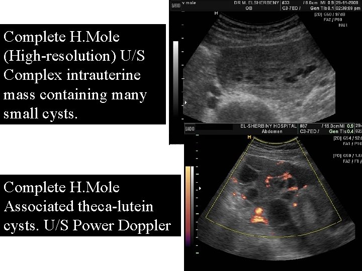 Complete H. Mole (High-resolution) U/S Complex intrauterine mass containing many small cysts. Complete H.