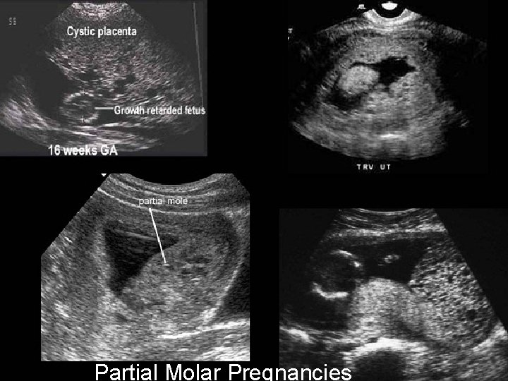 Partial Molar Pregnancies 