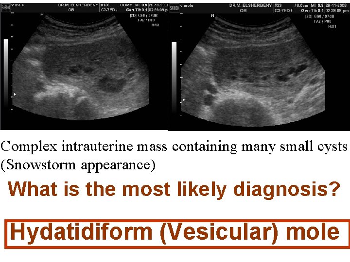 Complex intrauterine mass containing many small cysts (Snowstorm appearance) What is the most likely