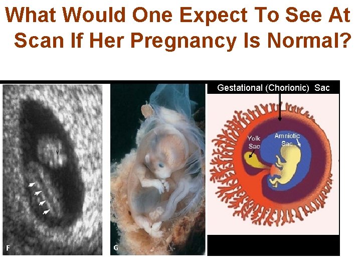  What Would One Expect To See At Scan If Her Pregnancy Is Normal?
