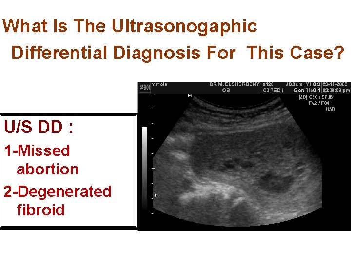  What Is The Ultrasonogaphic Differential Diagnosis For This Case? U/S DD : 1