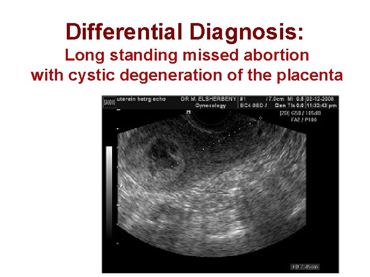 Differential Diagnosis: Long standing missed abortion with cystic degeneration of the placenta 